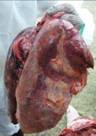 Pneumonia and pleurisy severe au