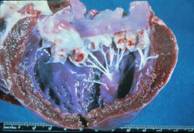 Endocardiosis B2