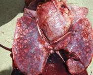 Pericarditis au 3