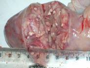 Pancreatitis au1