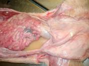 Abscess umbical peritonitis