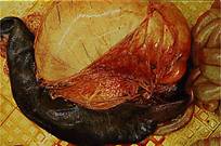 Torsion spleen stomach