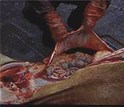 Gastric rupture adult