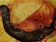 Torsion spleen stomach