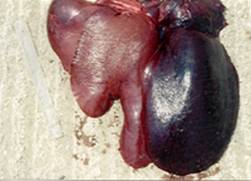 Liver torsion 2
