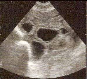 Pregultraearly2
