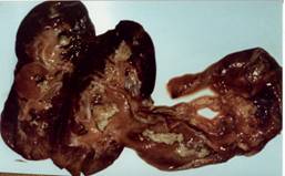 Urinary Pyelonephritis