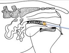 Repro-female-drawing1 catheter 2