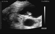23 day gestations