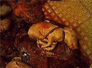 Stillborn placenta around neck